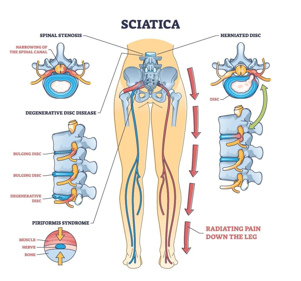 symptoms of sciatica, including radiating leg pain, numbness and weakness.