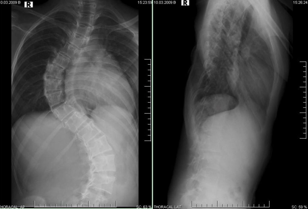 classification of scoliosis types, including idiopathic, congenital and degenerative.