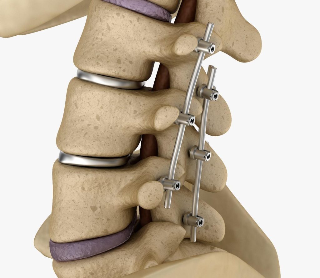 fracture fixation and trauma surgery in Singapore.