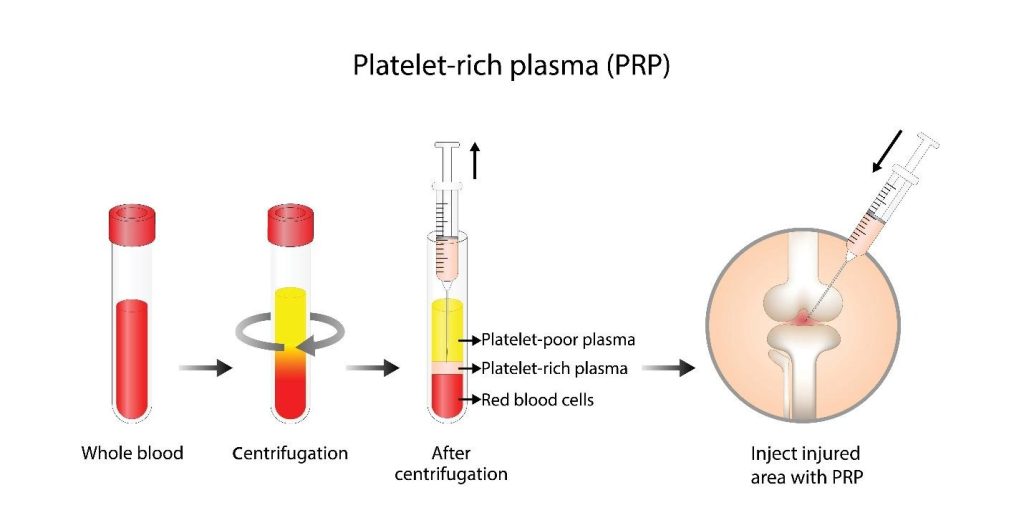 Platelet-rich plasma PRP treatment Singapore.