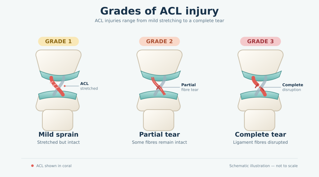 Diagram showing Grade 1 ACL sprain, Grade 2 partial ACL tear and Grade 3 complete ACL tear.
