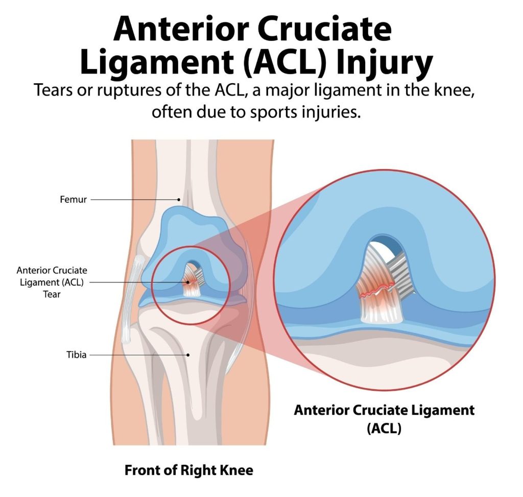 ACL tear recovery timeline week by week in Singapore.
