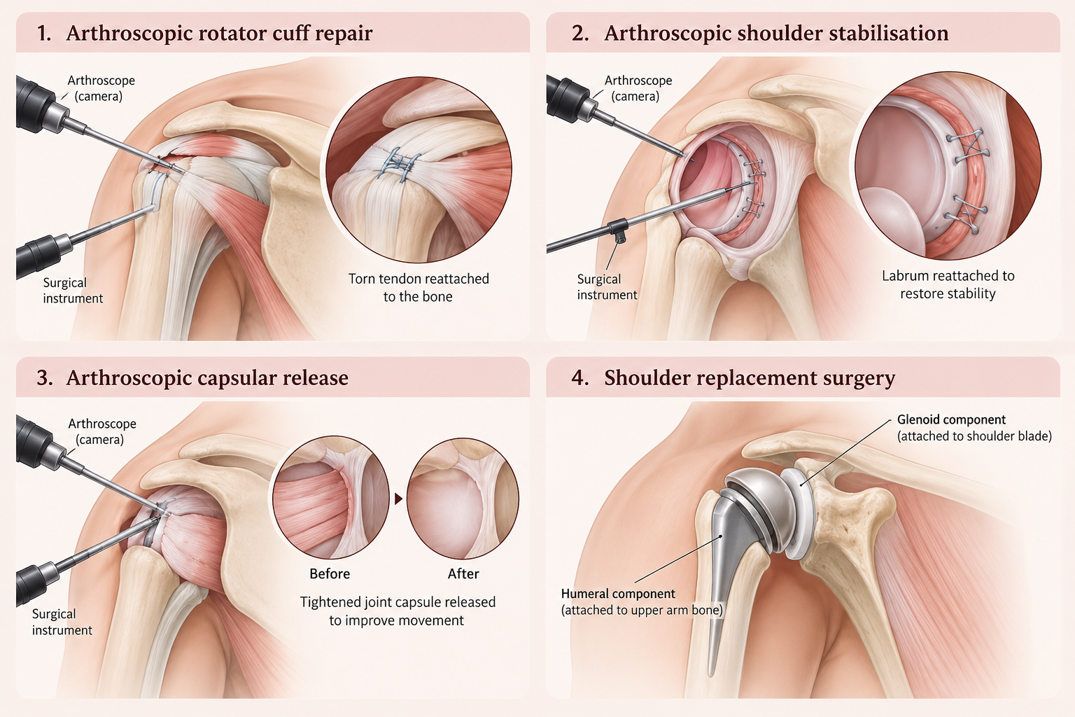 Medical illustrations showing arthroscopic rotator cuff repair, labral repair for shoulder stabilisation, capsular release for frozen shoulder and shoulder replacement.